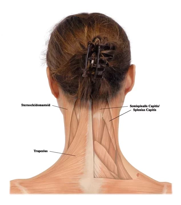 Anatomical illustration of neck and shoulder muscles treated for dystonia