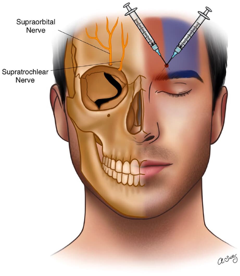 Anatomical illustration for Supraorbital Nerve Block